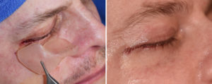 Custom Orbitozygomatic Implant Placement incision closure Dr Barry Eppley Indianapolis