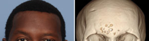 Forehead Asymmetry