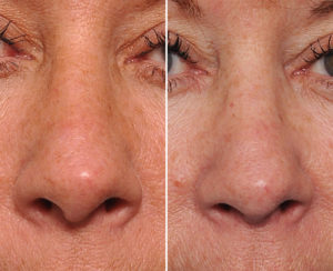 Hanging Columella Rhinoplasty correction result front view Dr Barry Eppley Indianapolis