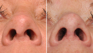 Hanging Columella Rhinoplasty result submental view Dr Barry Eppley Indianapolis