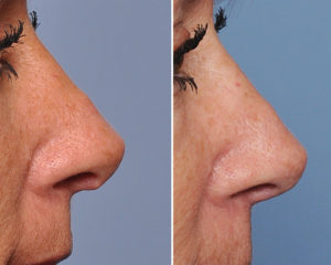 Hanging Columellar Rhinoplasty correction side view Dr Barry Eppley Indianapolis