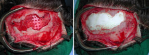 Hydroxyapatite Cement Forehead Defect Reconstruction intraop Dr Barry Eppley Indianapolis