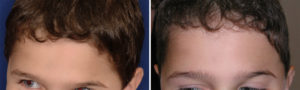 Hydroxyapatite Cement Forehead Reconstruction result Dr Barry Eppley Indianapolis