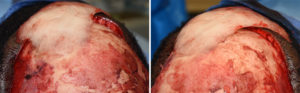 Intraoperative Custom Forehead Implant 2 Dr Barry Eppley Indianapolis