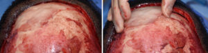 Intraoperative Custom Forehead Implant for Asymmetry Dr Barry Eppley Indianapolis
