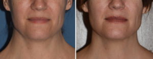 JV Webbed Neck Correction result front view Dr Barry Eppley Indianapolis