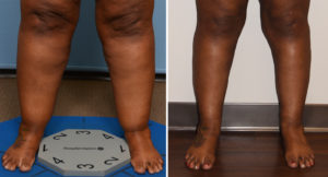 Large Cankle Liposuction result front view Dr Barry Eppley Indianapolis