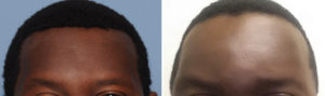 Left Foreheasd Augmentation Dr Barry Eppley Indianapolis