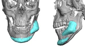 Malpositioned Jaw Angle Implant