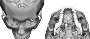 Old Infraorbital Rim Fractures Dr Barry Eppley Indianapolis