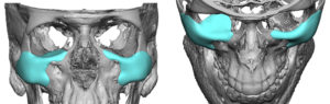 Orbital Dystopia Orbital Floor Implanty with Custom Cheek Implants design Ddr Barry Eppley Indianapolis