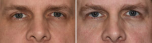 Orbital Floor Augmentation result front view Dr Barry Eppley Indianapolis
