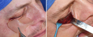 Orbitozygomatic Implant placement for Facial Asymmetry Dr Barry Eppley Indianapolis