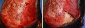 Posterior Temporal Muscle Resection and Parietal Skull reduction intraop bnefore and after Dr Barry Eppley Indianapolis