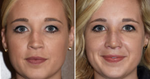 Rhinoplasty Splint Removal front view Dr Barry Eppley Indianapolis