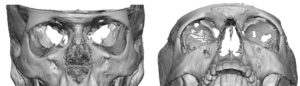 Right Orbital Dystopia 3D CT scan Dr Barry Eppley Indianapolis