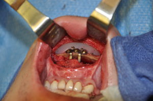 Sliding Genioplasty with Chin Implant Dr Barry Eppley Indianapolis