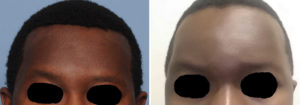 Temporal Muscle Reduction result front view Dr Barry Eppley Indianapolis
