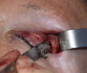 Trtanspalpebrfal Brow Bone Reduction intraop Dr Barry Eppley Indianapolis