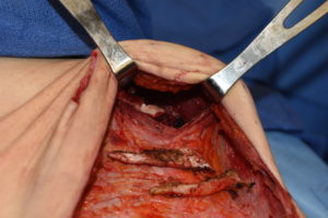 Tummy Tuck Rib Removal Dr Barry Eppley Indianapolis