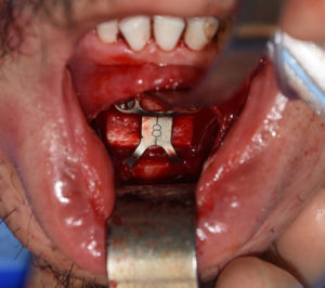 Vertical Lengthening Genioplasty with interpositional bone graft Dr Barry Eppley Indianapolis