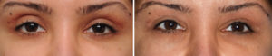Wider Eye Blepharoplasties result Dr Barry Eppley Indianapolis