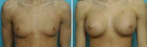 Young Breast Augmentation results front view Dr Barry Eppley Indianapolis