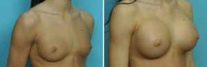 Young Breast Augmentation results oblique view Dr Barry Eppley Indianapolis