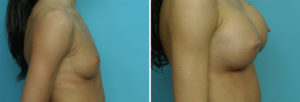 Young Breast Augmentation results side view Dr Barry Eppley Indianapolis