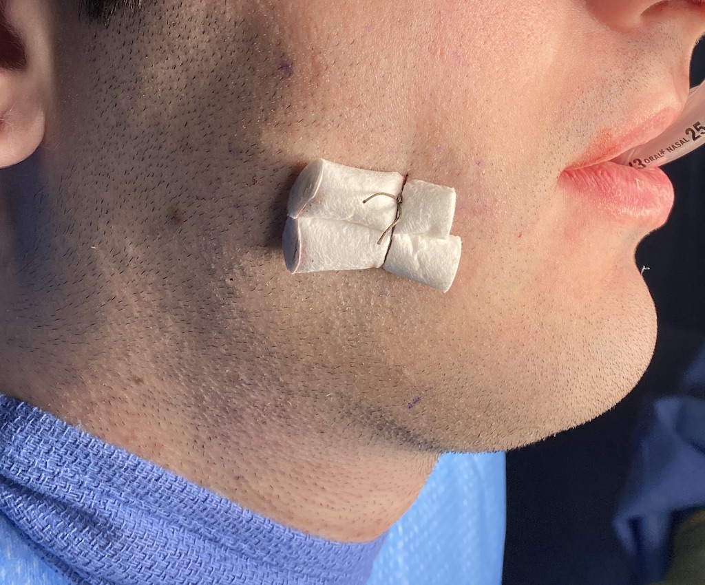 Technical Strategies - Bolster Dressing for Buccinator Myectomies and Perioral Liposuction - Explore Plastic Surgery Technical Strategies - Bolster Dressing for Buccinator Myectomies and Perioral Liposuction - Explore Plastic Surgery