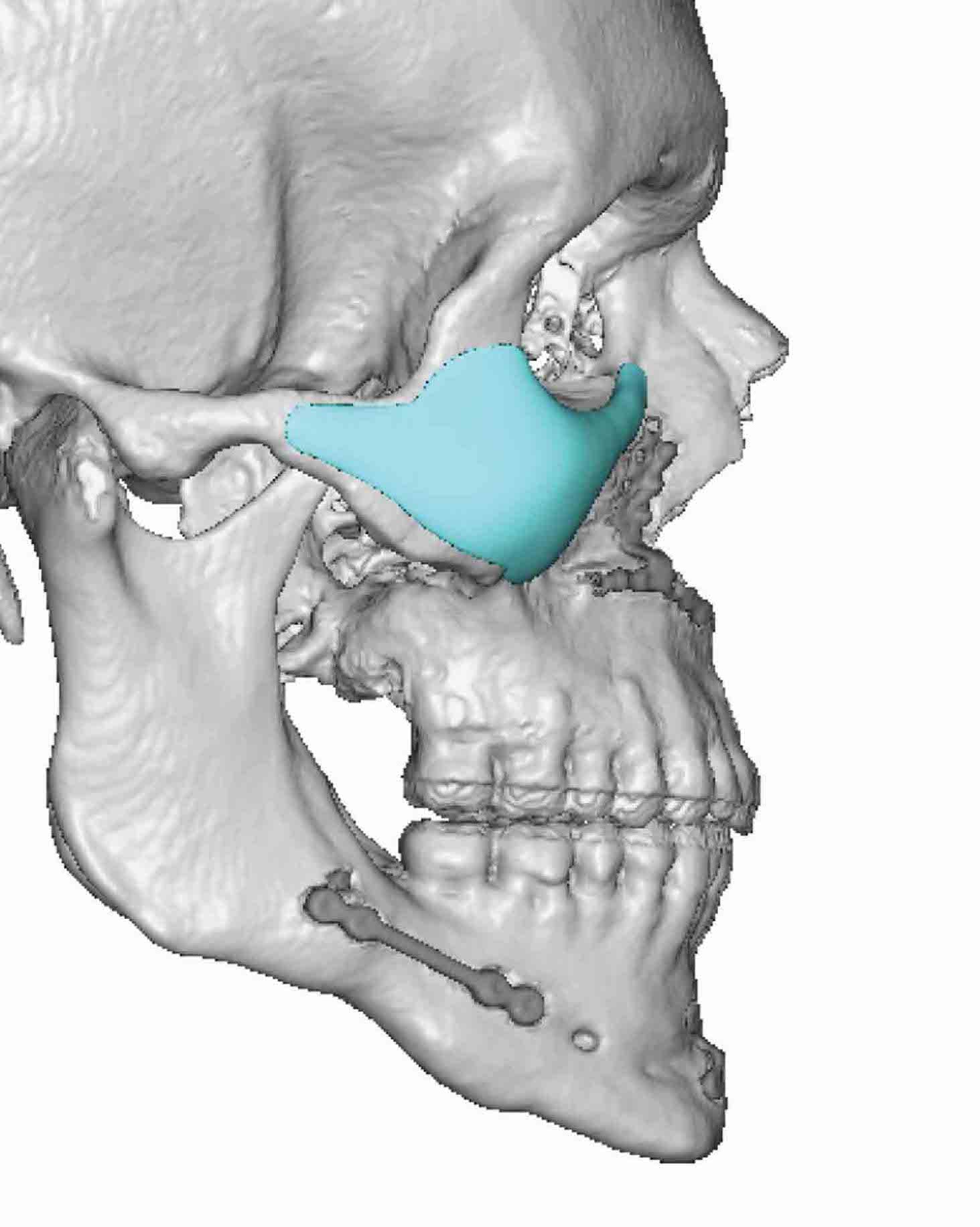 Plastic Surgery Case Study - Secondary Custom Infraorbital-Malar