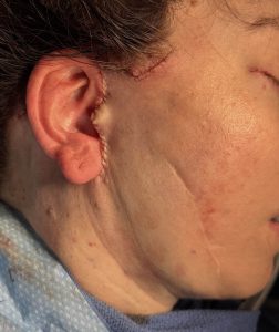 OR Snapshots - The Effects of a Facelift on a Regional Scar