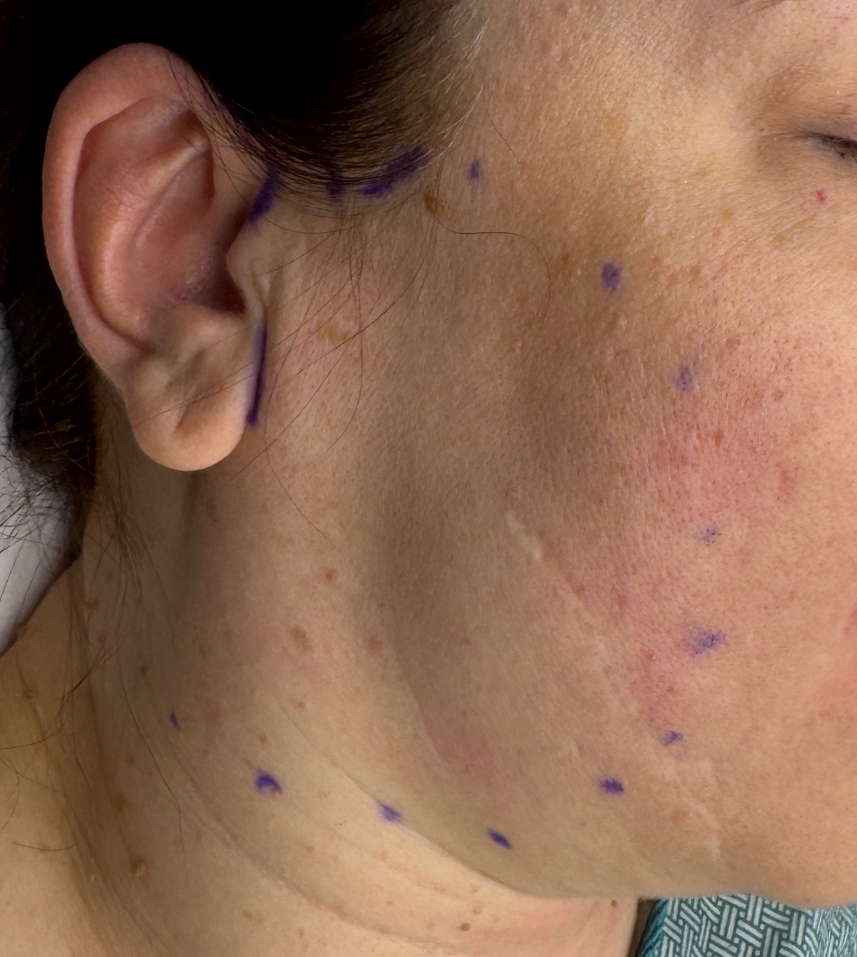 SCAR FACES 新品・未開封 OR Snapshots - The Effects of a Facelift on a Regional Scar