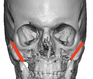 ZSO-cheekbone-reduction-