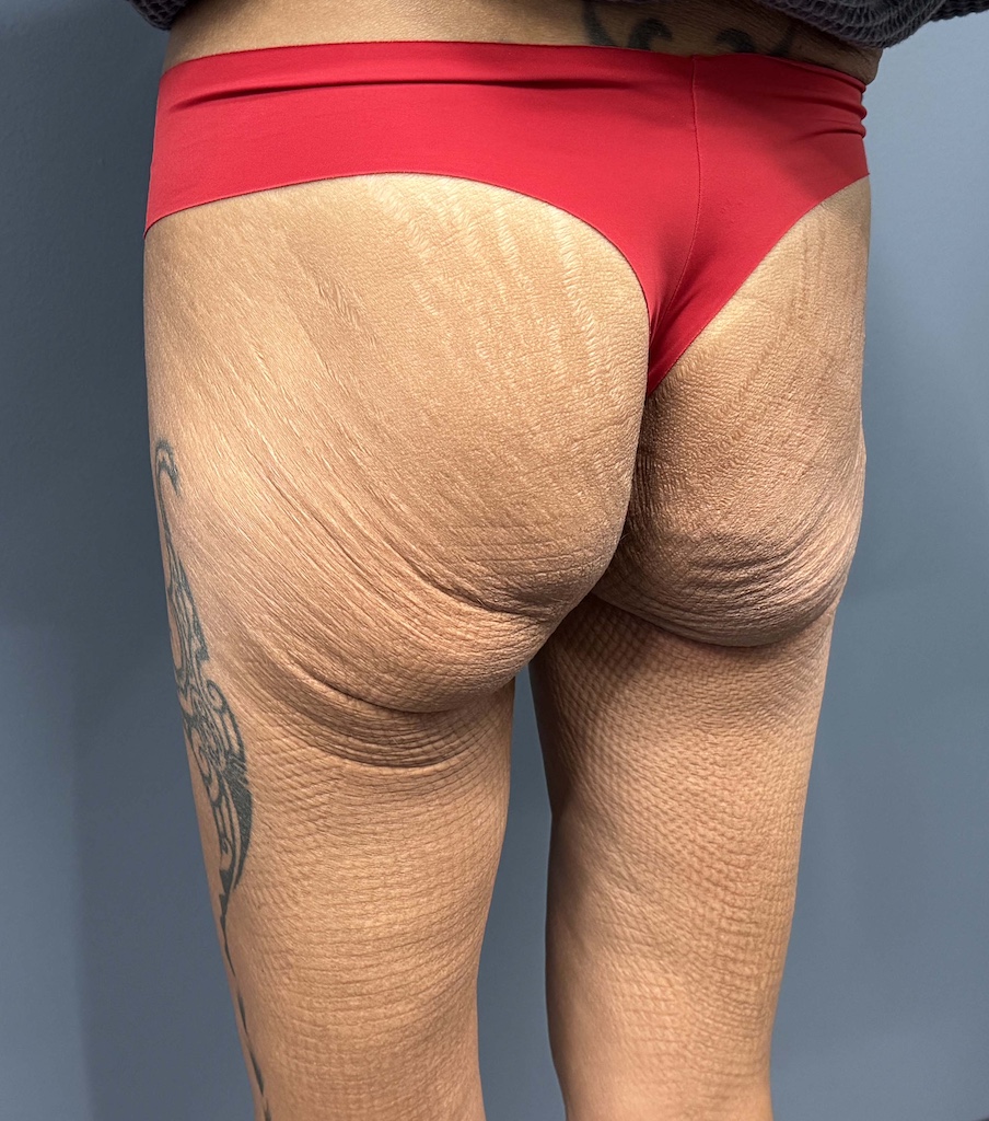 Lower Buttock Lift Case Study