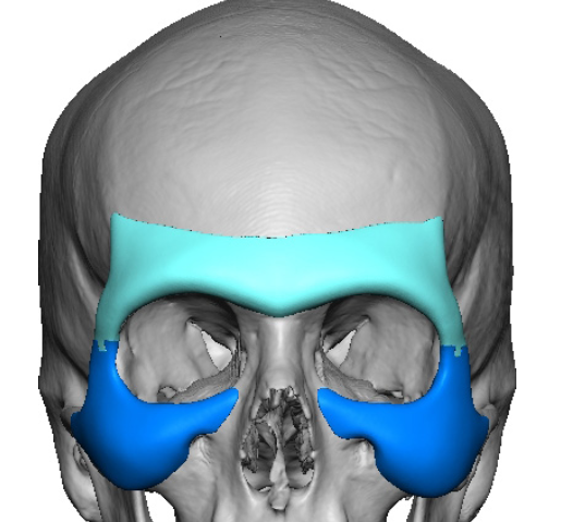 The Custom Orbital Frame Implant Case Study - Explore Plastic Surgery