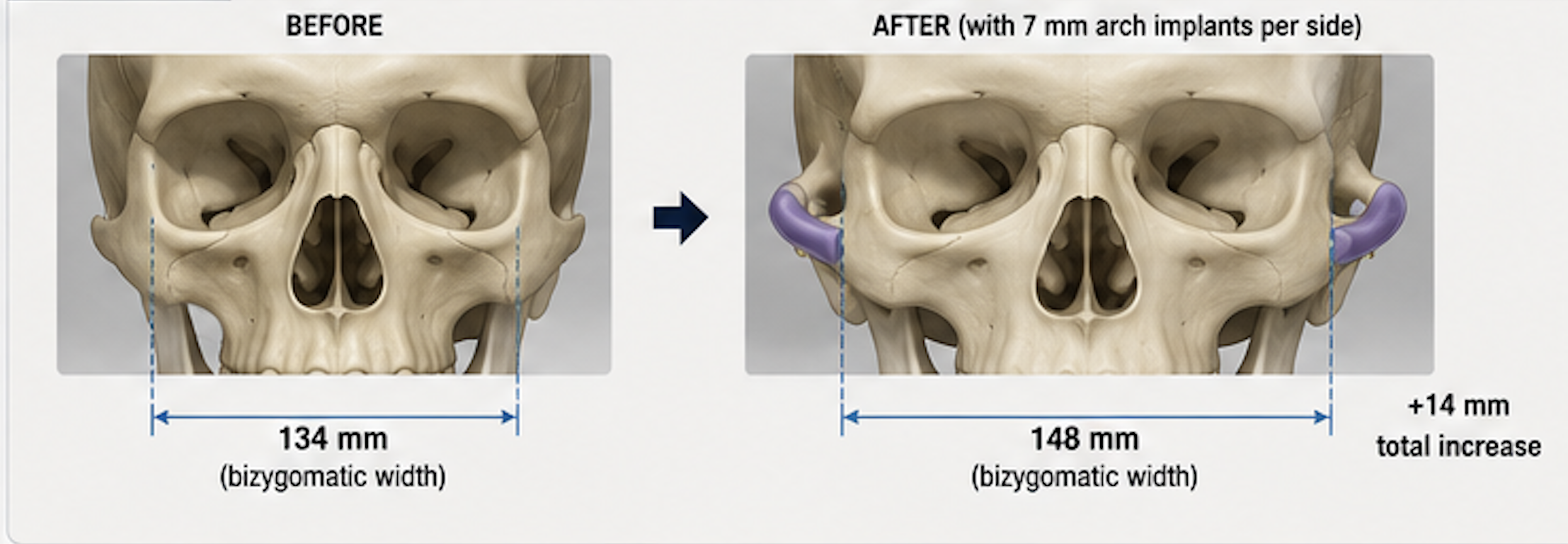 【SURGERY】bone embossing ma-1 Custom Zygomatic Arch Implant Designs - Explore Plastic Surgery