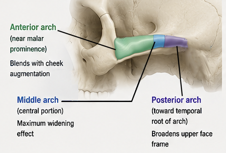 【SURGERY】bone embossing ma-1 Custom Zygomatic Arch Implant Designs - Explore Plastic Surgery